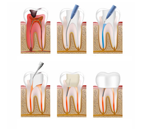 Should You Be Afraid Of Having Root Canal Treatment?