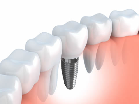 Dental Implants – Strong and Secure Replacement of Lost Teeth