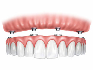 Implant retained dentures