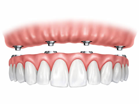 A World Beyond Dentures – The Dental Implant Revolution
