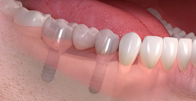 Avoiding Problems With Dental Implants