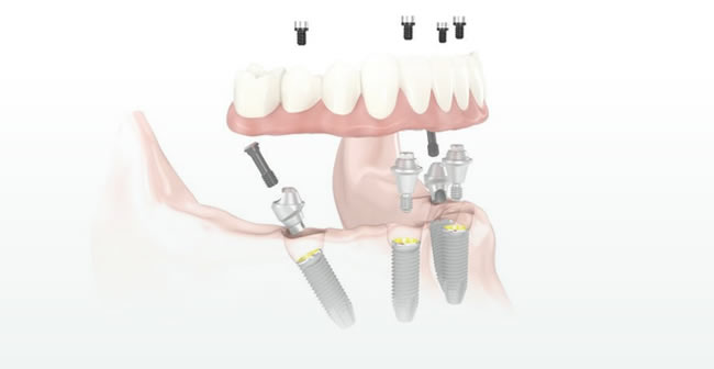 Same Day Dental Implants In Canterbury