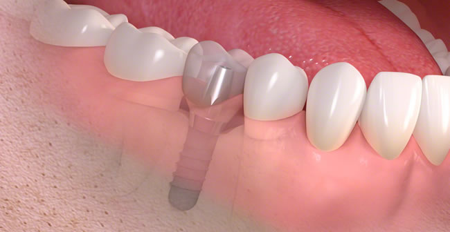 Planning Ahead For Your New Dental Implant