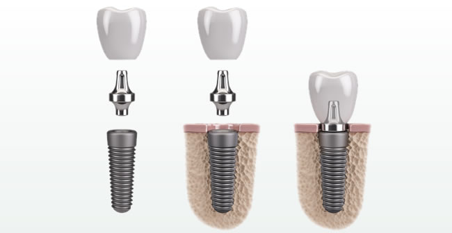 Are You Tempted By Cheap Dental Implants?