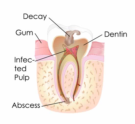 Root Canal Procedure Or An Extraction?